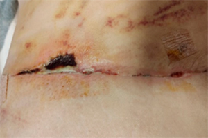 Deiscência de sutura